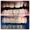 Riabilitazione in Zirconio- Ceramica degli elementi 131211212223